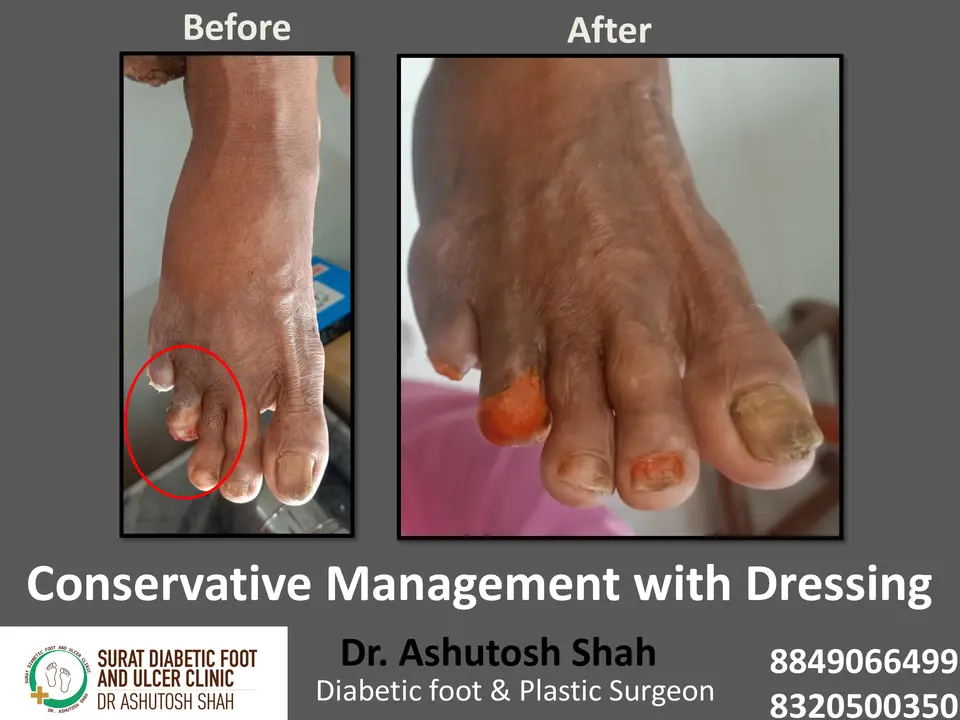 Diabetic Foot  PPT 3 checked by sir.pptx-46.webp